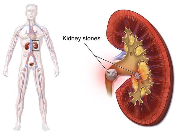 Kidney Stones And High Blood Pressure: A Preventative Connection