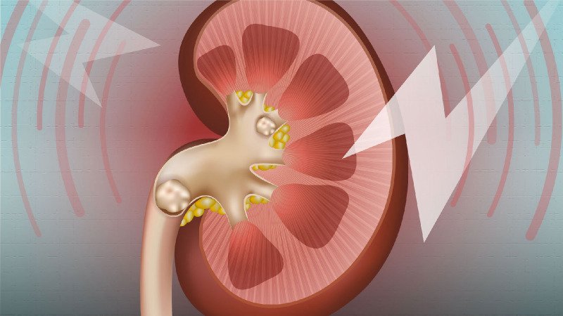 Kidney Stones And High Blood Pressure: A Preventative Connection