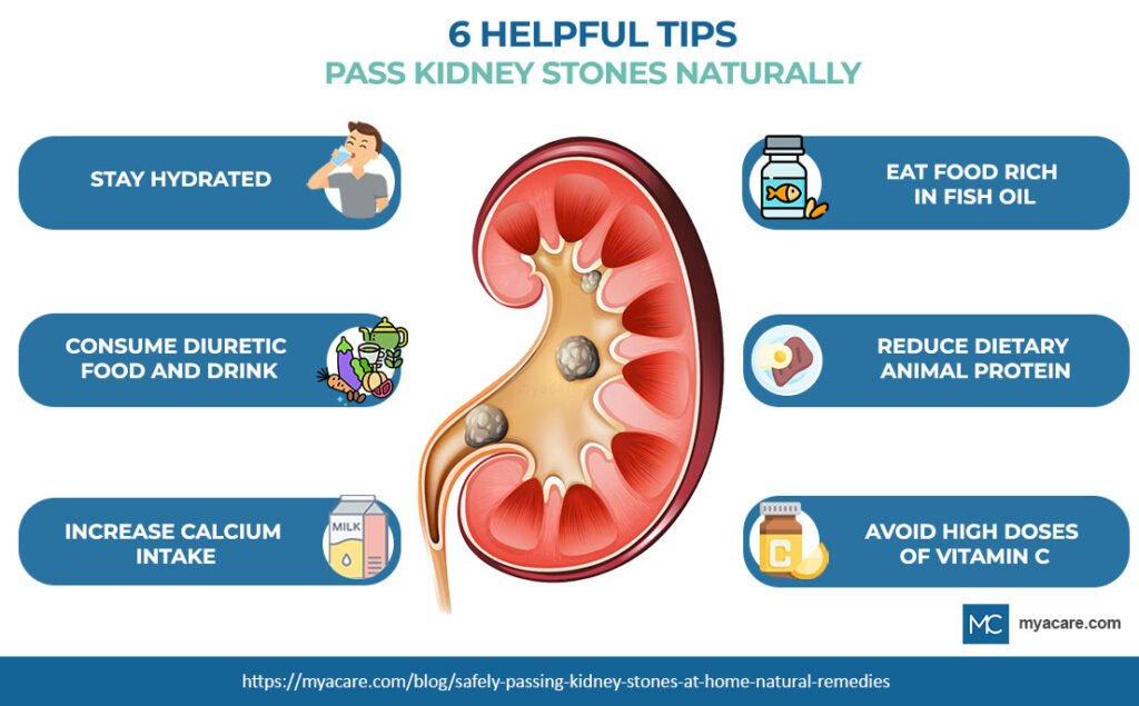 Kidney Stones And Mental Well-Being: Strategies For Prevention