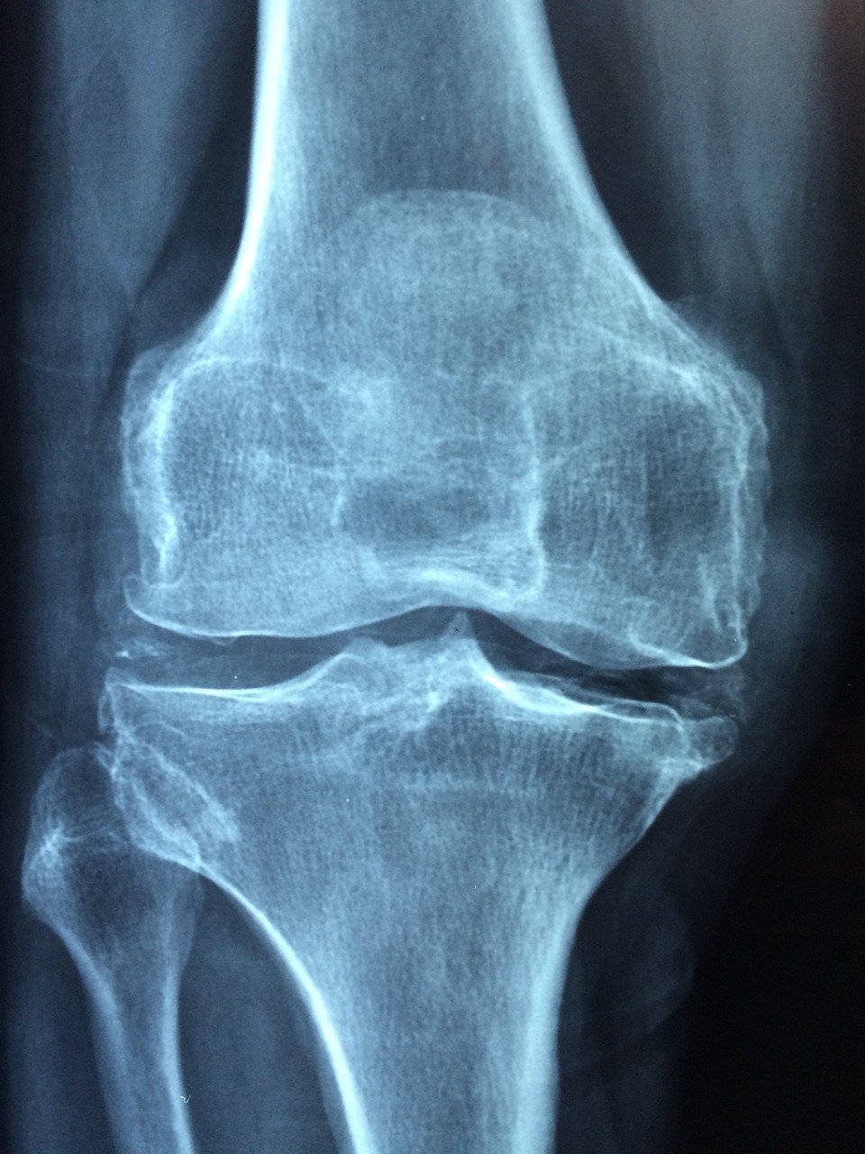 Oxalates And Their Impact On Bone Health